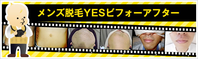 メンズ脱毛YESビフォーアフター