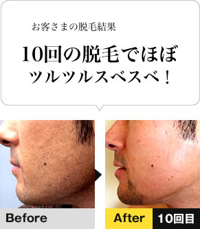 10回の脱毛で効果絶大！