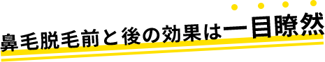 鼻毛脱毛前と後の効果は一目瞭然