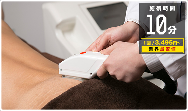 Oライン脱毛が15分4500円！
