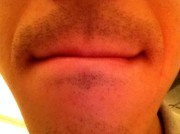 顔脱毛　男性脱毛