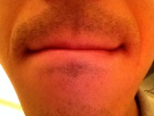 顔脱毛　男性脱毛