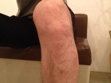 30分　男性脱毛