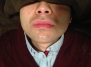 顔脱毛　男性脱毛